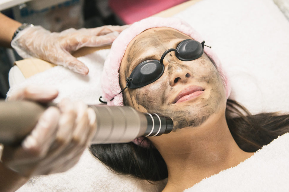 Carbon Laser Peel