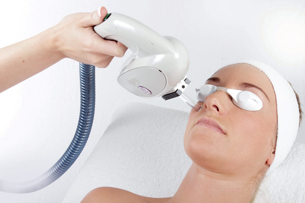 IPL Thread Vein Removal