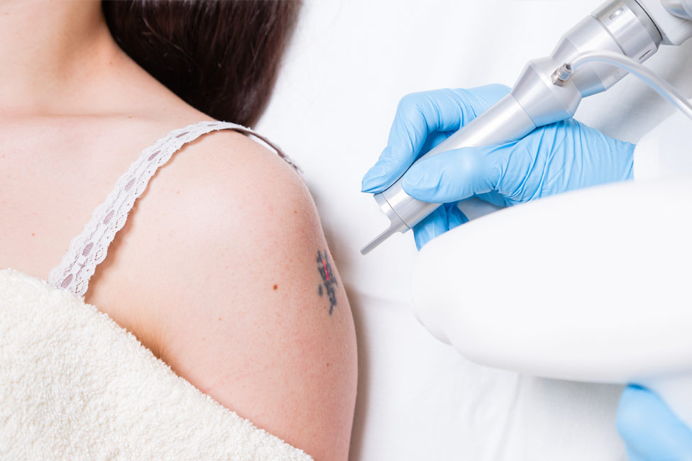 Laser Tattoo Removal